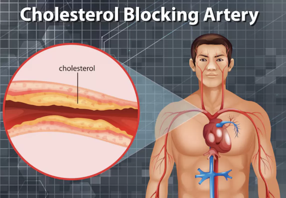 Mengungkap Misteri Kolesterol