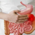 Gejala Usus Buntu yang Wajib Diwaspadai
